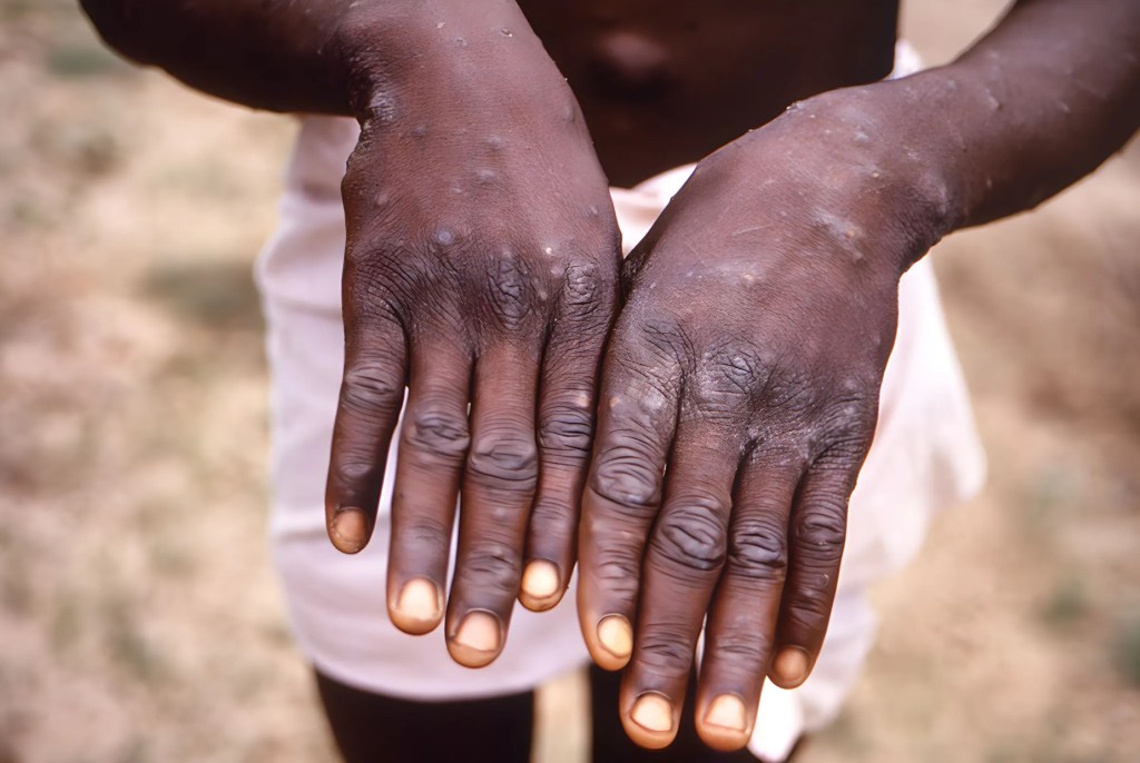 Mpox Mutation 2024: New Strain Challenges Global Containment&nbsp;Efforts