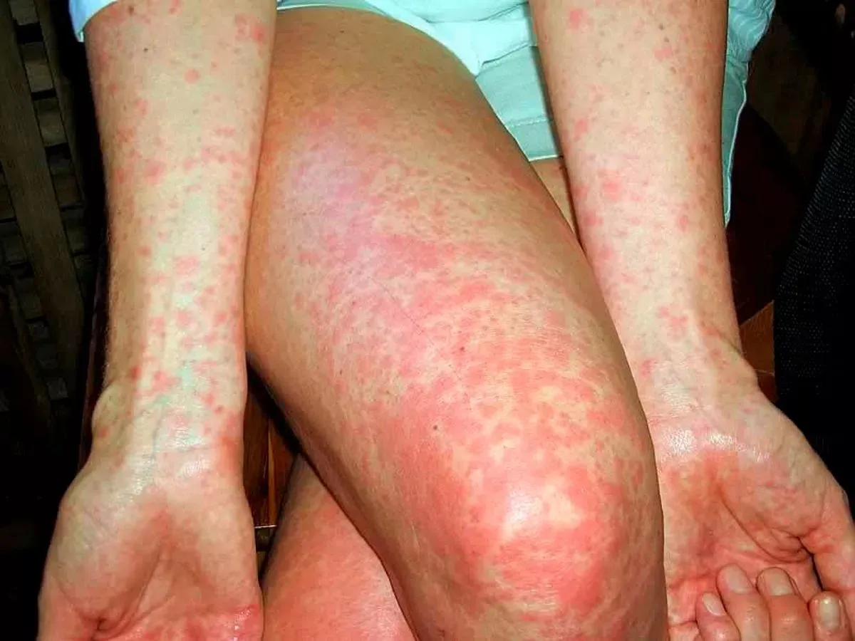 scarlet fever uae
