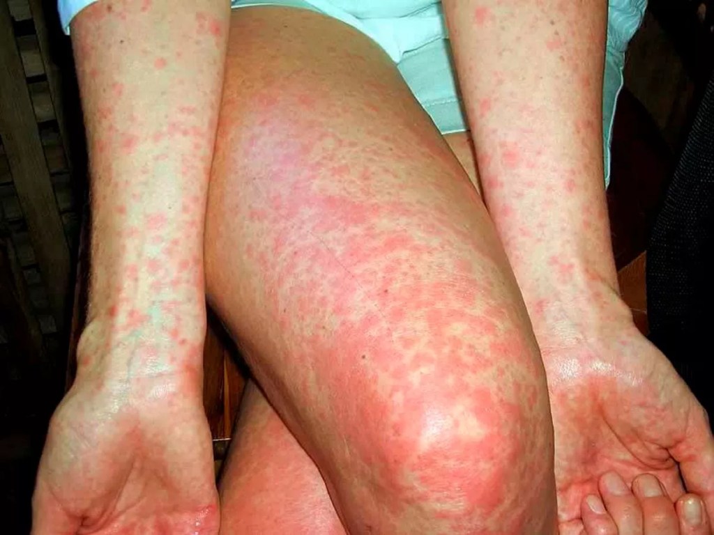 scarlet fever uae